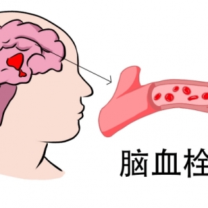 血栓的症状是什么