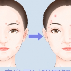 水痘的传播途径