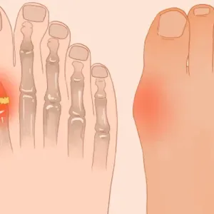痛风能吃板栗吗